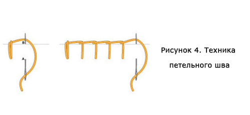 Рисунок 4. Техника петельного шва